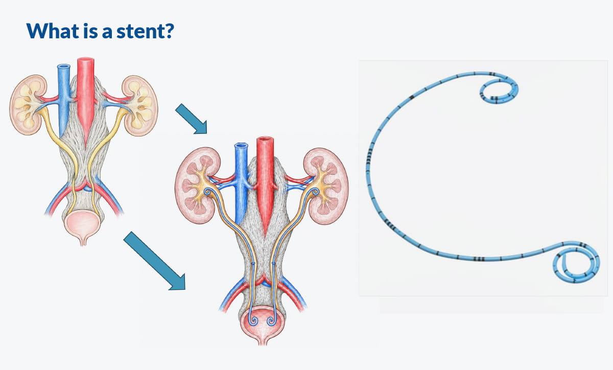 IgG4ward_Academy_Chapter 9_RPF_Lesson 3_Image 2_What is a Stent _1200x724pxl.jpg