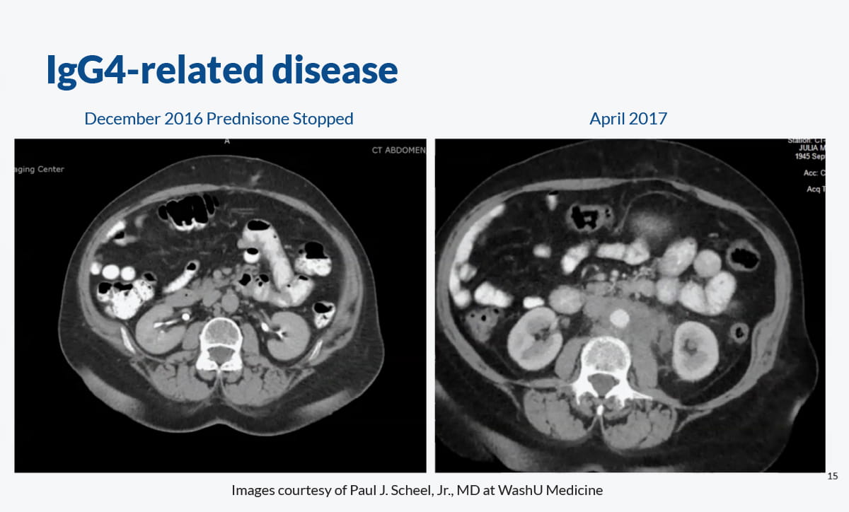 IgG4ward_Academy_Chapter 9_RPF_Lesson 3_Image 5_Monitoring Recurrence_1200x724pxl.jpg