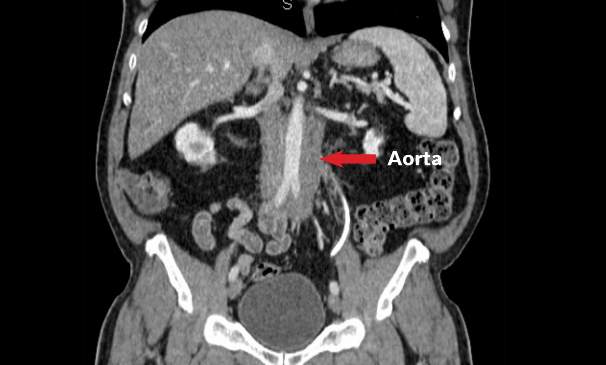 IgG4ward_Academy_Chapter-9_RPF_Lesson-1_Image-3_CT-Scan_RPF-Aorta_1200x724pxl.jpg