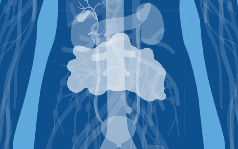 Organ affected: retroperitoneum