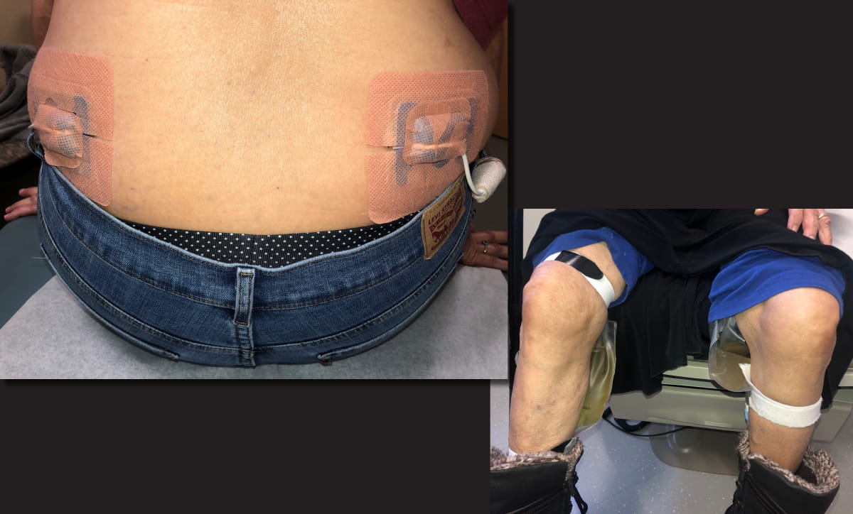 IgG4ward_Academy_Chapter 9_RPF_Lesson 3_Image 3_Nephrostomy_1200x724pxl.jpg