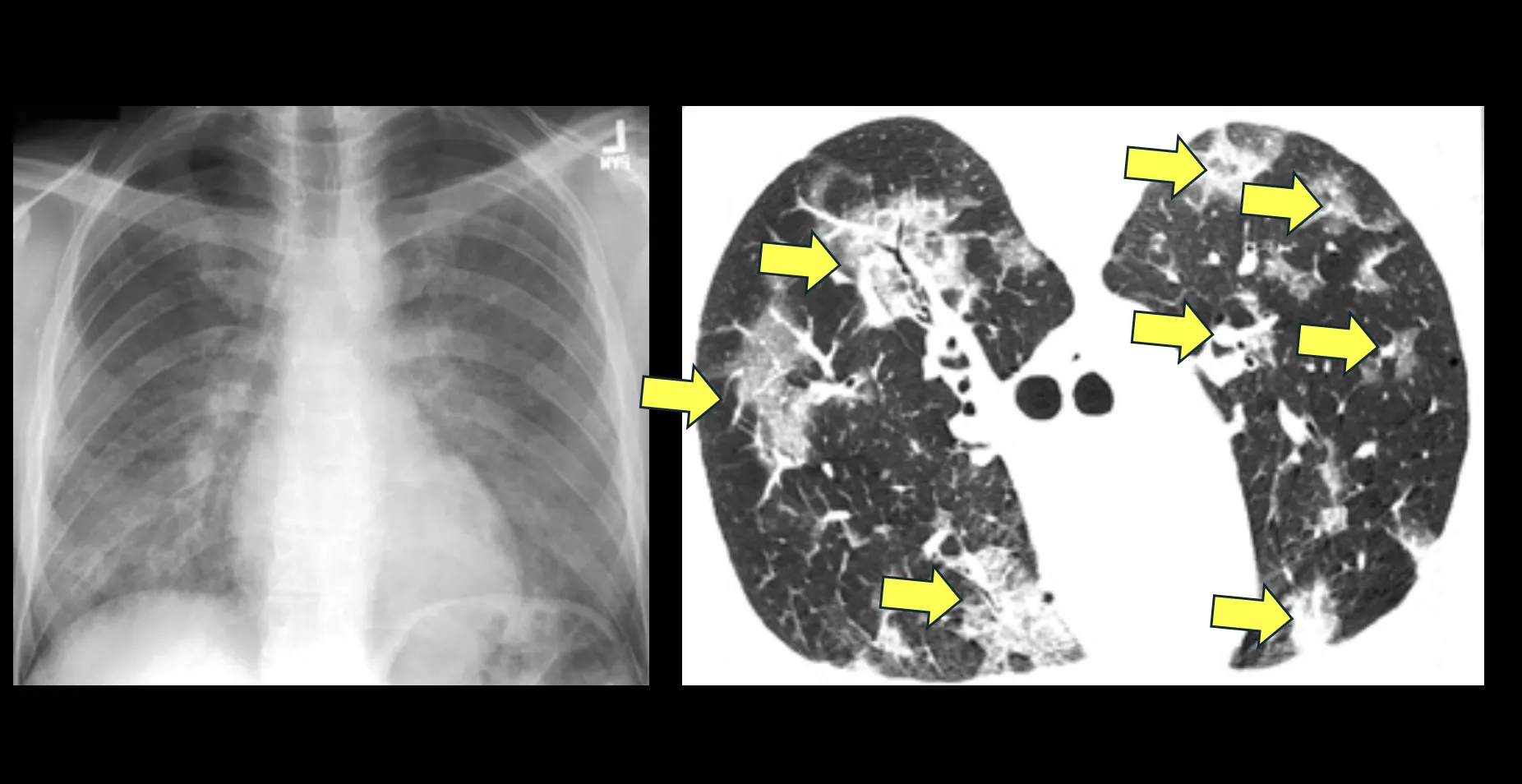 Pneumocystis jiroveci pneumonia.jpg