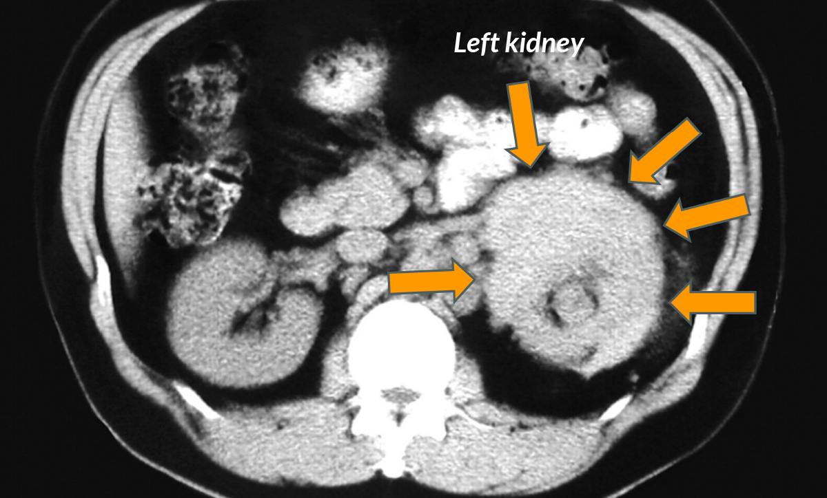 IgG4ward_Academy_Chapter-9_RPF_Lesson-1_Image-4_CT-Scan_RPF-Kidney_1200x724pxl.jpg